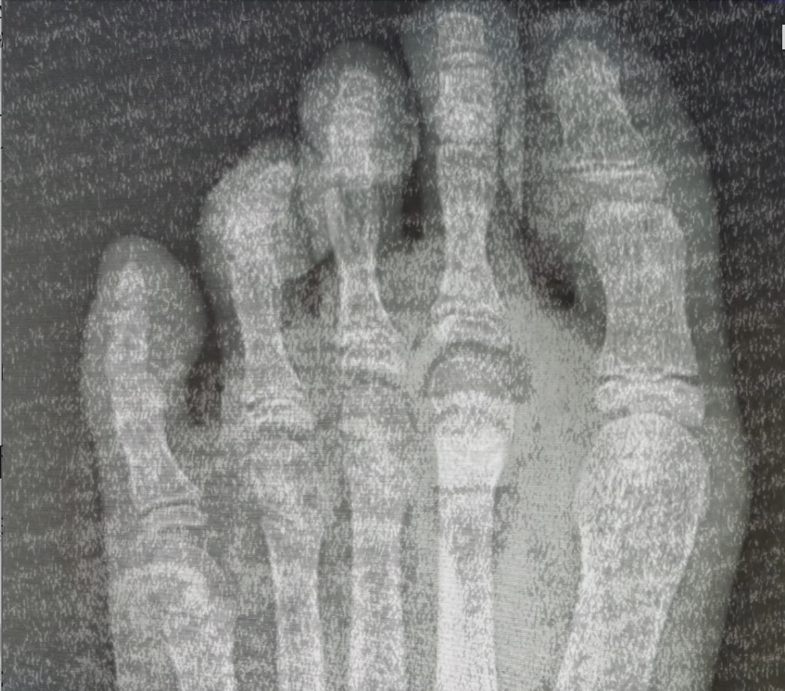 怪我（骨挫傷）で練習ができない日々の記録